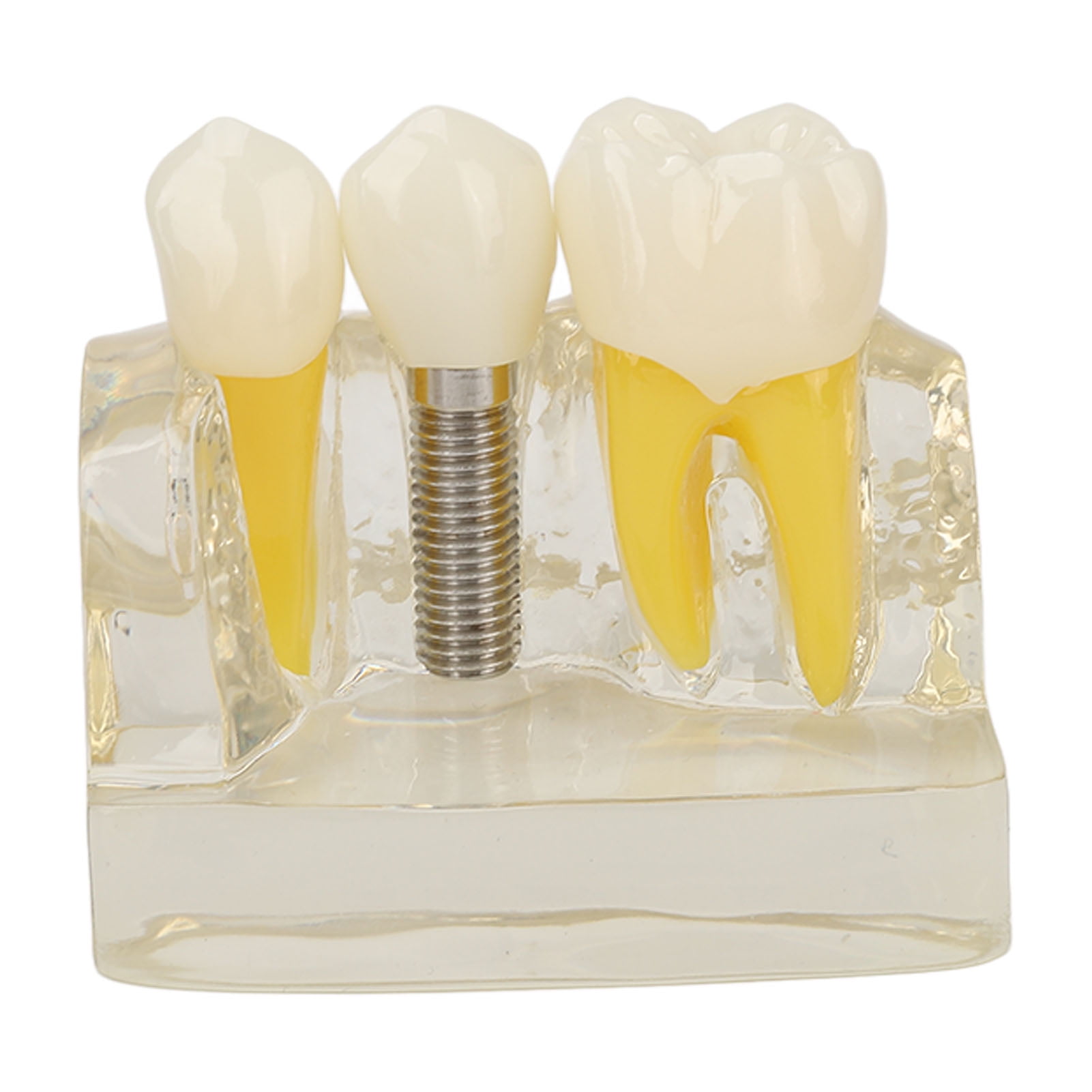 Teeth Implant Model, Transparent Implant Tooth Model For Demonstration