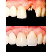 Temporary Tooth Set Temp Missing DIY Safe Easy Video Link included (Bright Shade)