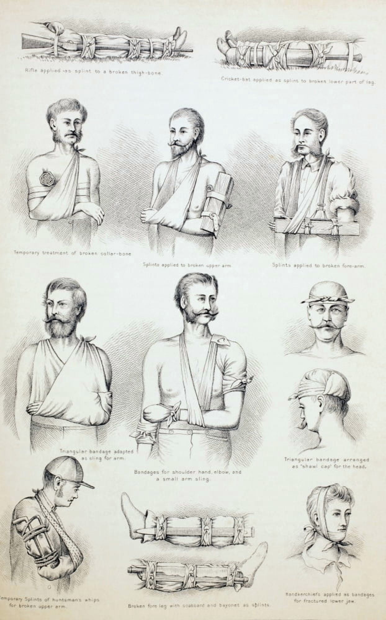 Temporary Treatment Of Fractures From The Household Physician Published Circa 1890 Canvas Art - Ken Welsh Design Pics (22 x 36)