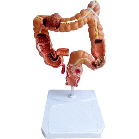 Tesyar Life-Size Human Large Intestine Colon Pathology Model, PVC Digestive System Anatomical Teaching Study Model