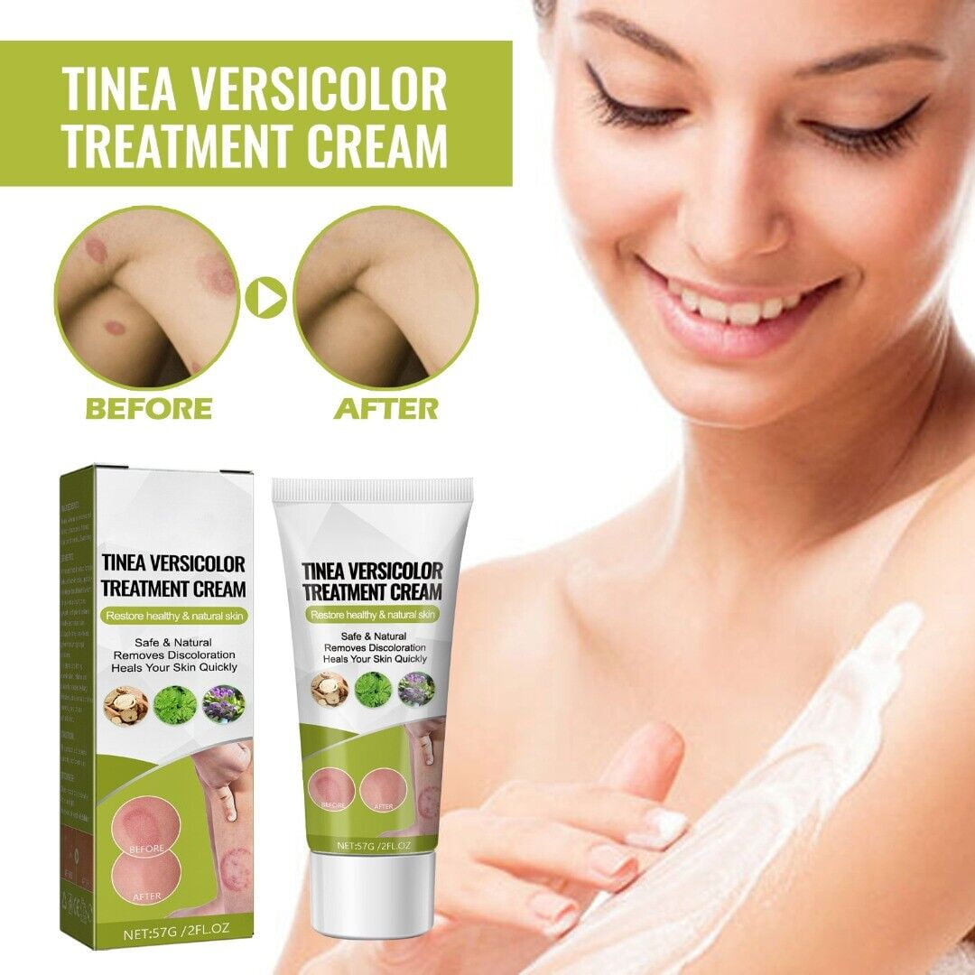 Tinea Versicolor Treatment Cream Body Antifungal Gel for Tinea