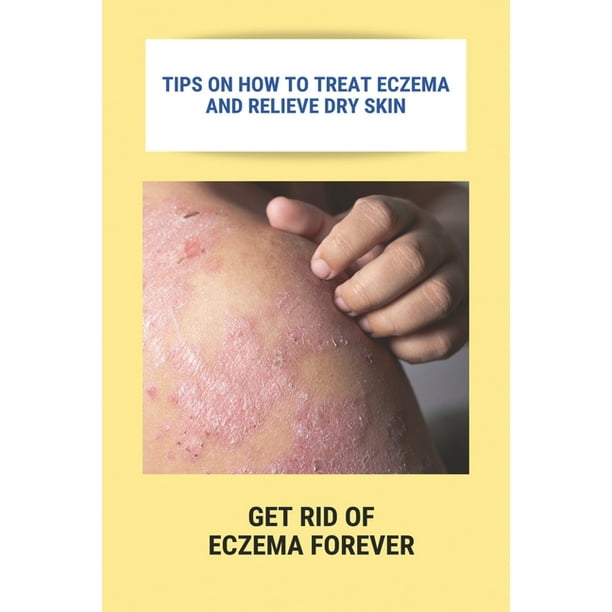 Tips On How To Treat Eczema And Relieve Dry Skin : Get Rid Of Eczema ...