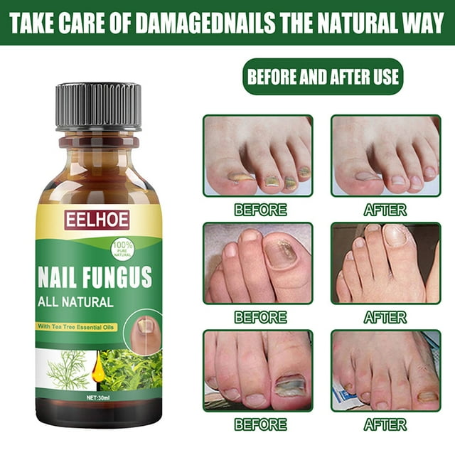 Toe nail tea tree oil fungus care solution onychomycosis antibacterial