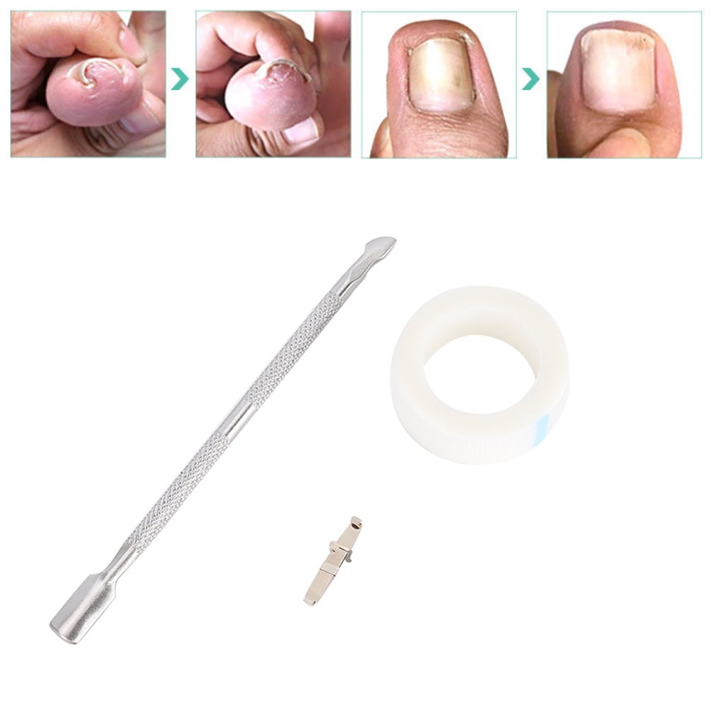 Toenail Corrector Sticker, Ingrown Toenail Tools, Ingrown Toenail