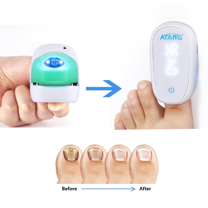 Nail Fungus Device Laser Therapy for Fungi Care Maximum Strength Anti Toenail Fungal
