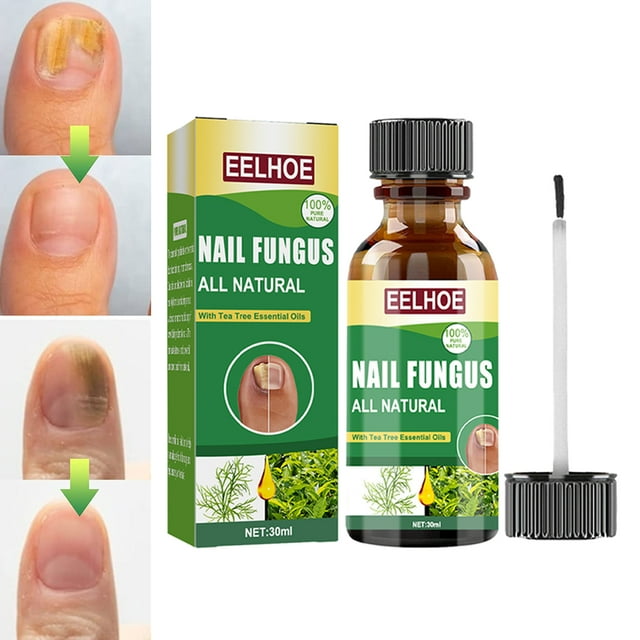 Toenail Fungus Treatment, Effective Nail Fungus Treatment for Toenail ...