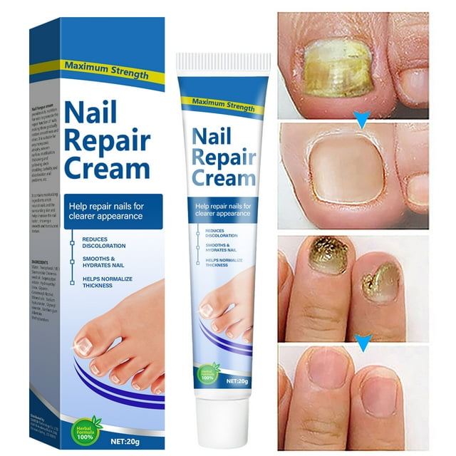Toenail Fungus Treatment, Nail Repair Cream, Toe Nail Treatment Extra