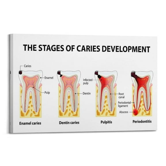 Tooth Decay Stages Poster The Stages of Caries Development Poster Teeth Medical Wall Art Dental Post Poster for Room Aesthetic Posters & Prints on Canvas Wall Art Poster for Room