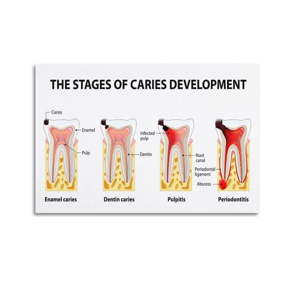 Tooth Decay Stages Poster The Stages of Caries Development Poster Teeth Medical Wall Art Dental Post Poster for Room Aesthetic Posters & Prints on Canvas Wall Art Poster for Room
