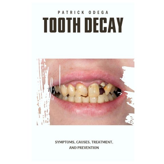 Tooth Decay: Symptoms, Causes, Treatment, and Prevention (Paperback) by Patrick Odega
