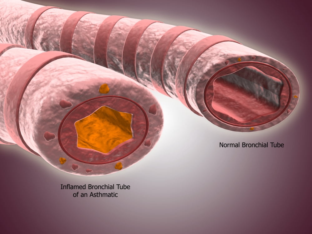Trachea cross-section showing normal and asthmatic bronchiole Canvas Art - Stocktrek Images (17 x 13)