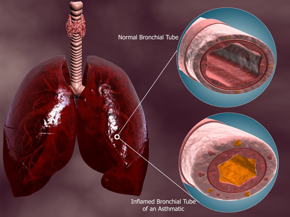 Trachea cross-section with lungs showing normal and asthmatic bronchiole Canvas Art - Stocktrek Images (33 x 25)