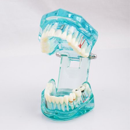 Transparent Dental Model for Studying Tooth Pathology & Anatomy - Ideal for Dental Students and Professionals, Perfect for In-depth Learning and Anatomical Visualization
