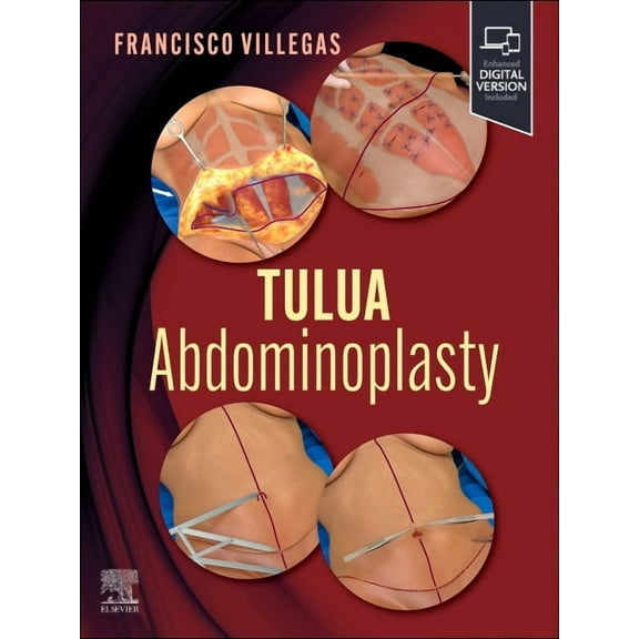 Tulua Abdominoplasty: Transverse Plication Technique, (Hardcover)