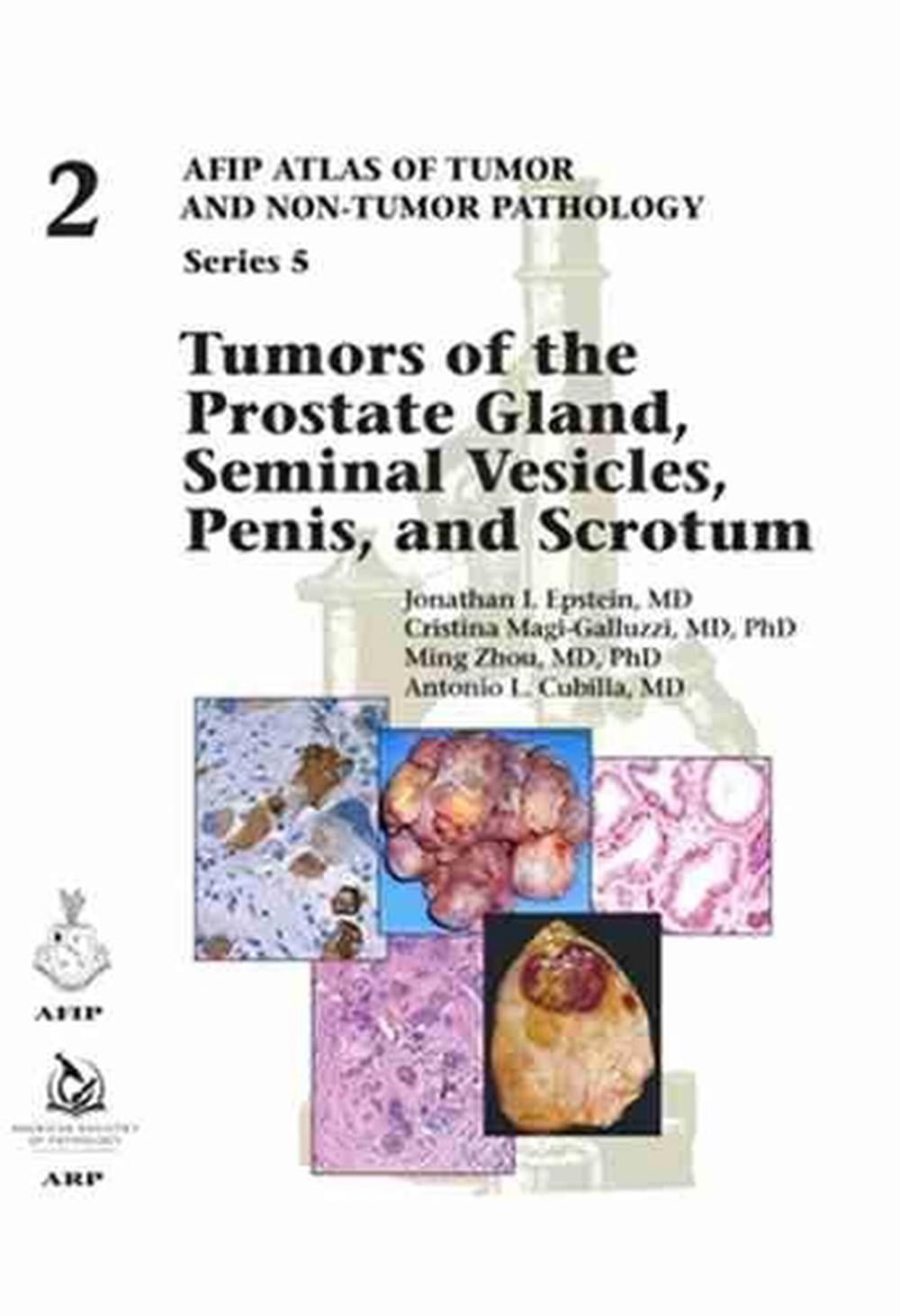 Tumors Of The Prostate Gland, Seminal Vesicles, Penis, And Scrotum - Walmart.com Tumors Of The Prostate Gland, Seminal Vesicles, Penis, And Scrotum - Walmart.com