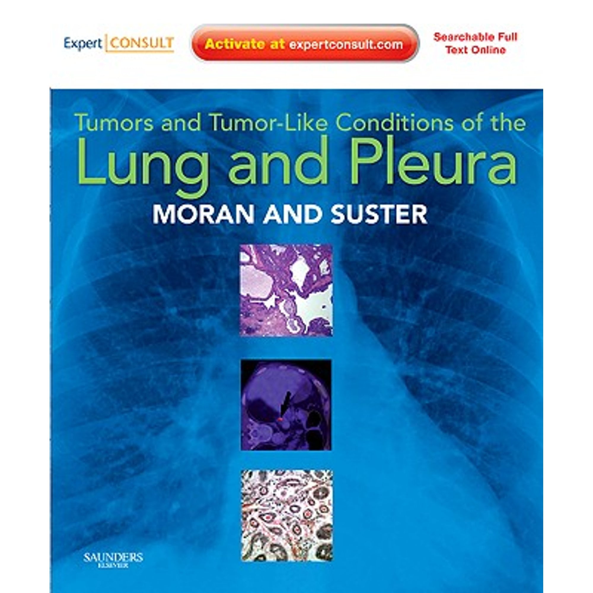 Tumors and Tumor-Like Conditions of the Lung and Pleura (Hardcover) by ...