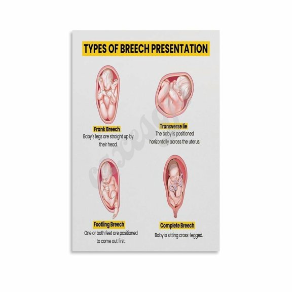 Types of Breech Presentation Poster Birth Education Wall Art Clinic Decor Canvas Painting Wall Art
