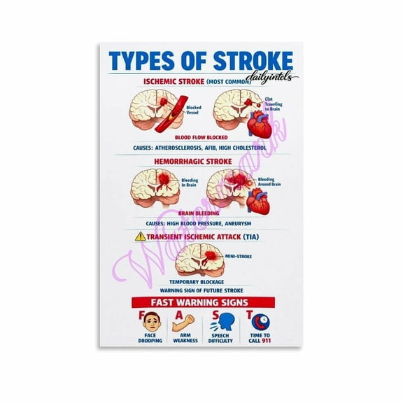 Types of Stroke & FAST Warning Signs Prevent, And Act Fast Poster Canvas Painting Wall Art Poster