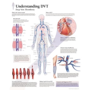 Understanding DVT chart : Laminated Wall Chart (Wallchart)
