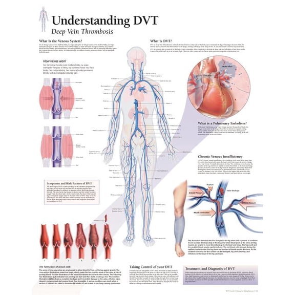 Understanding DVT chart : Laminated Wall Chart (Wallchart)