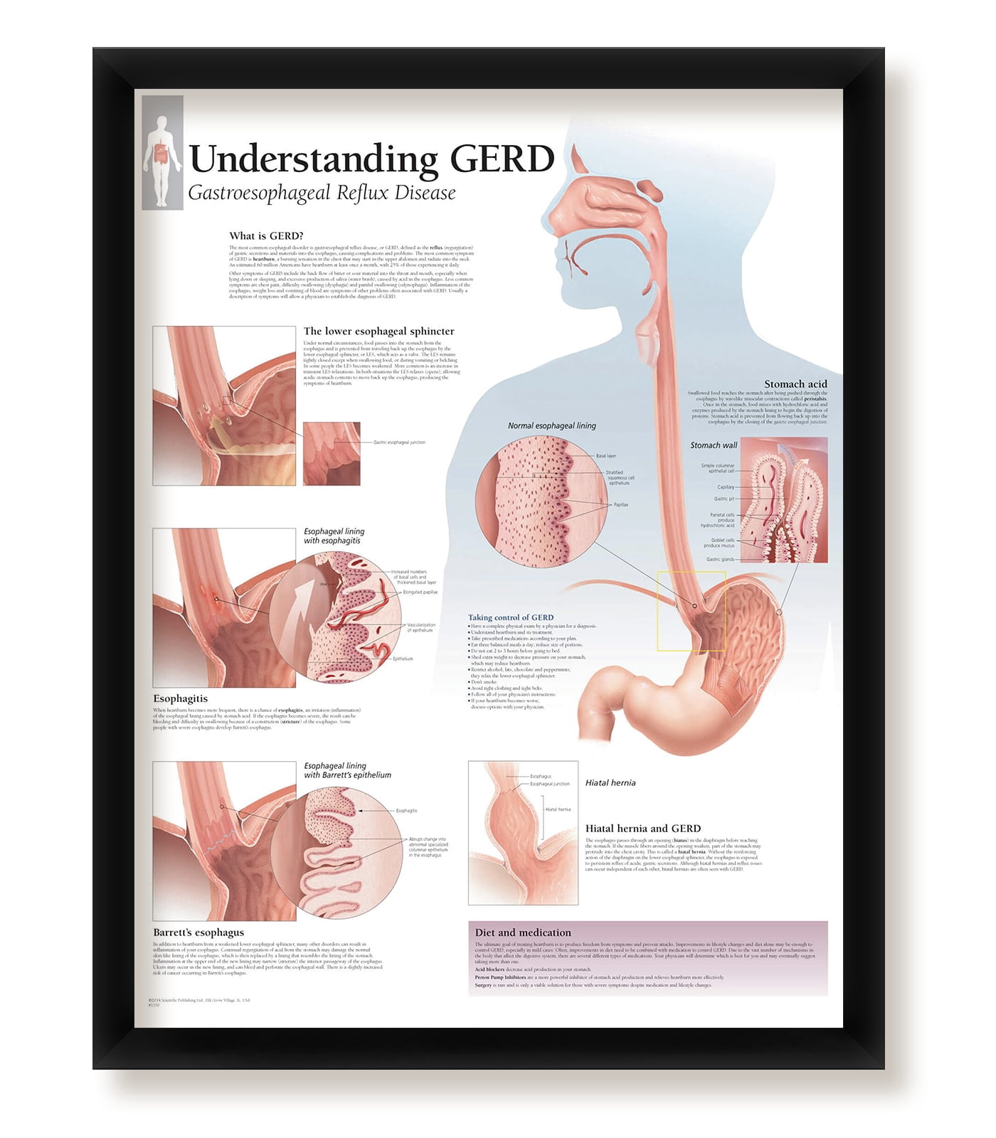 Understanding GERD Framed Medical Educational Informational Poster ...