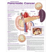 Understanding Pancreatic Cancer Anatomical Chart Other