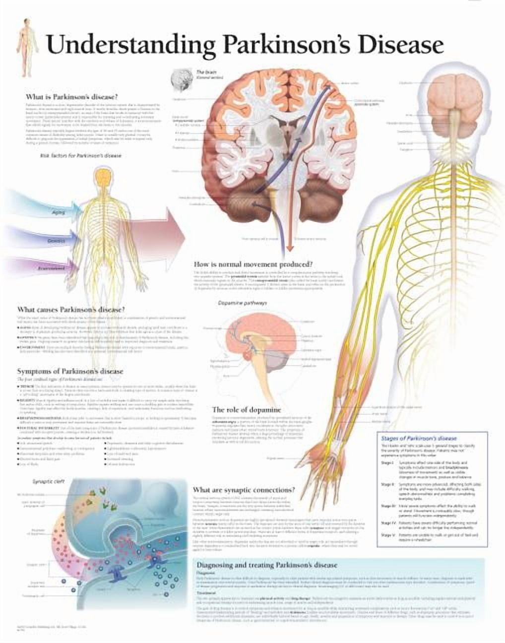 Understanding Parkinson's chart : Laminated Wall Chart (Wallchart)