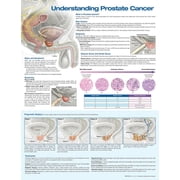 Understanding Prostate Cancer Anatomical Chart Other