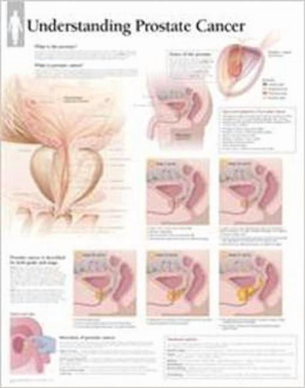 Protate Chart Understanding Prostate Cancer Wall Chart (Wallchart) - Walmart.com