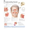 thumbnail image 1 of Understanding Sinusitis chart : Wall Chart (Wallchart), 1 of 8