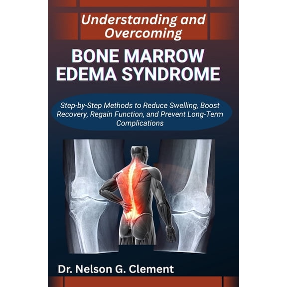 Understanding and Overcoming Bone Marrow Edema Syndrome: Step-by-Step Methods to Reduce Swelling, Boost Recovery, Regain, (Paperback)