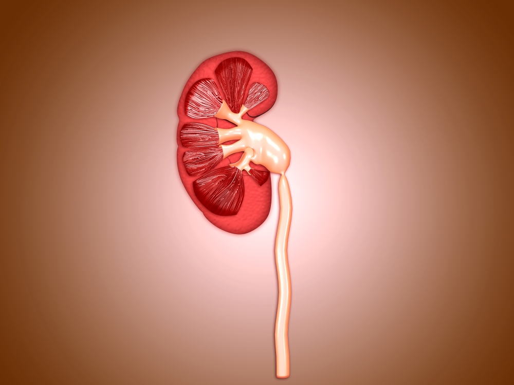 Ureteropelvic junction (UPJ) obstruction in the kidney Canvas Art - Stocktrek Images (33 x 25)