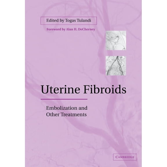 Uterine Fibroids: Embolization and Other Treatments, (Paperback)