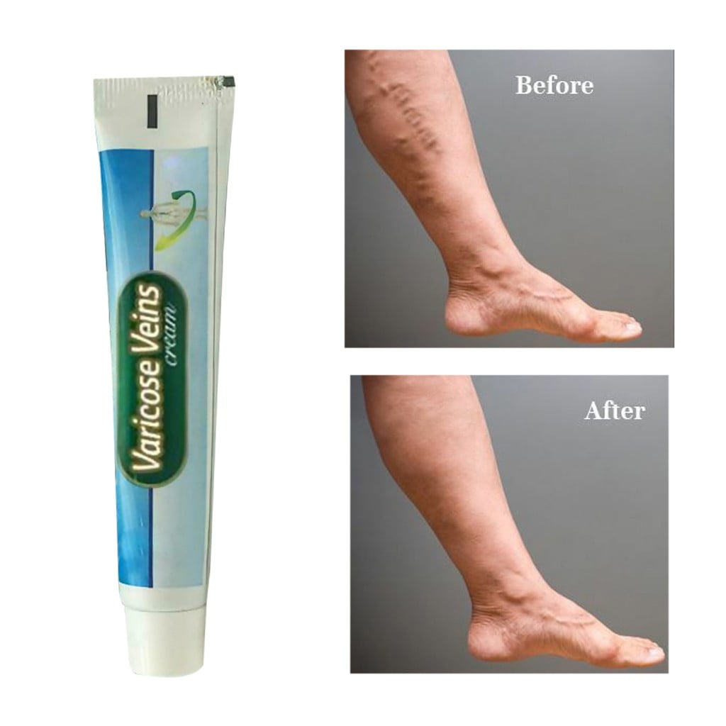 Varicose Veins Leg Bilges Bad Vasculitis Comb Be Water You Made A Fool