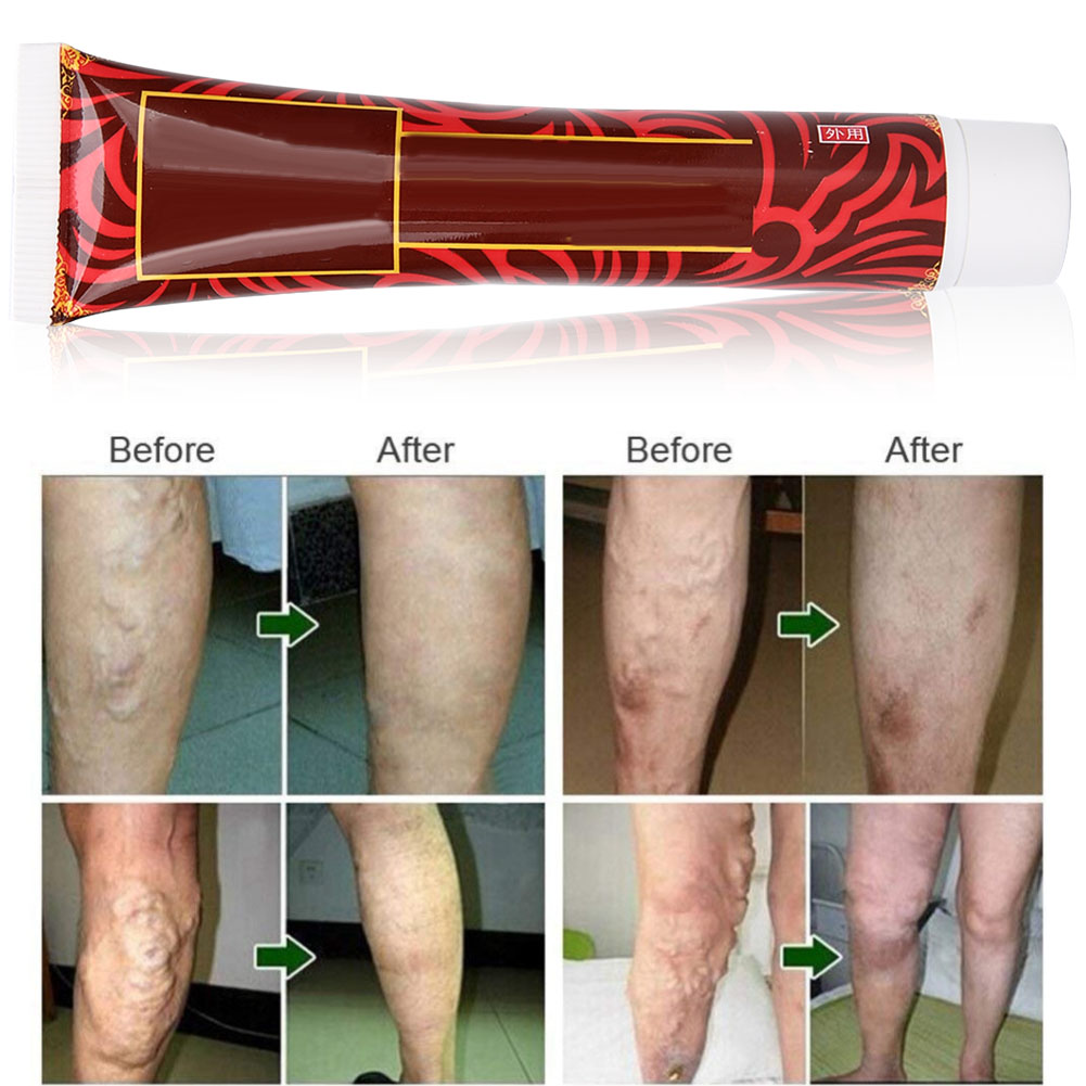 Varicose Veins Lotion, Spider Veins Cream For Edema Removal, Swollen