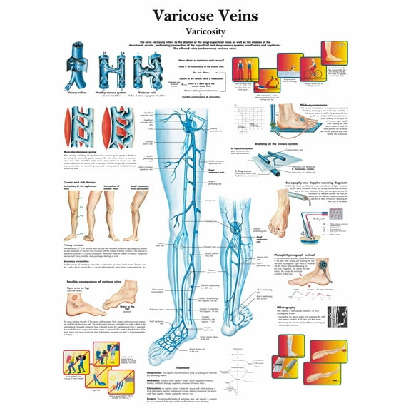 Varicose Veins Wall Art Posters Canvas Print Artwork Wall Chart Human Anatomy Wall Painting Office Hospital Room Home Decoration (without Framed),Multicolor,16x19.7 inch(40x50 cm)