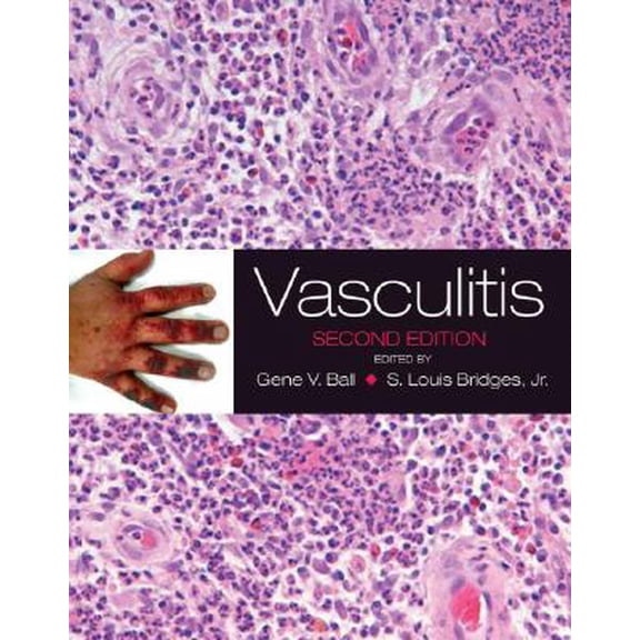 Pre-Owned Vasculitis