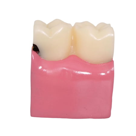 Vaveren 6 Times Morphology s Canal Caries Tooth Model for Kids Studying Patients