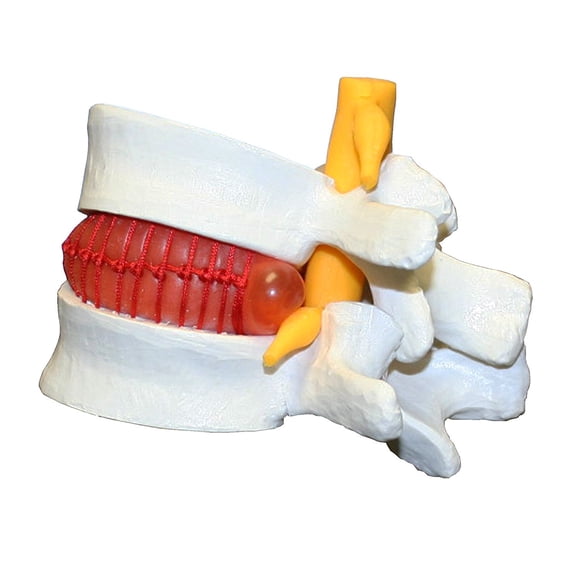Vision Scientific Prolapsed Intervertebral Disc