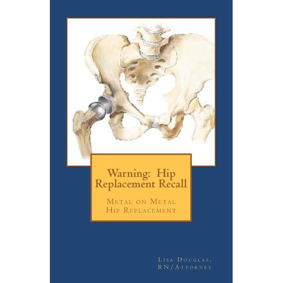 Warning: Hip Replacement Recall: Warning: Hip Replacement Recall Metal on Metal Devices Paperback 1461042356 9781461042358 Lisa G. Douglas