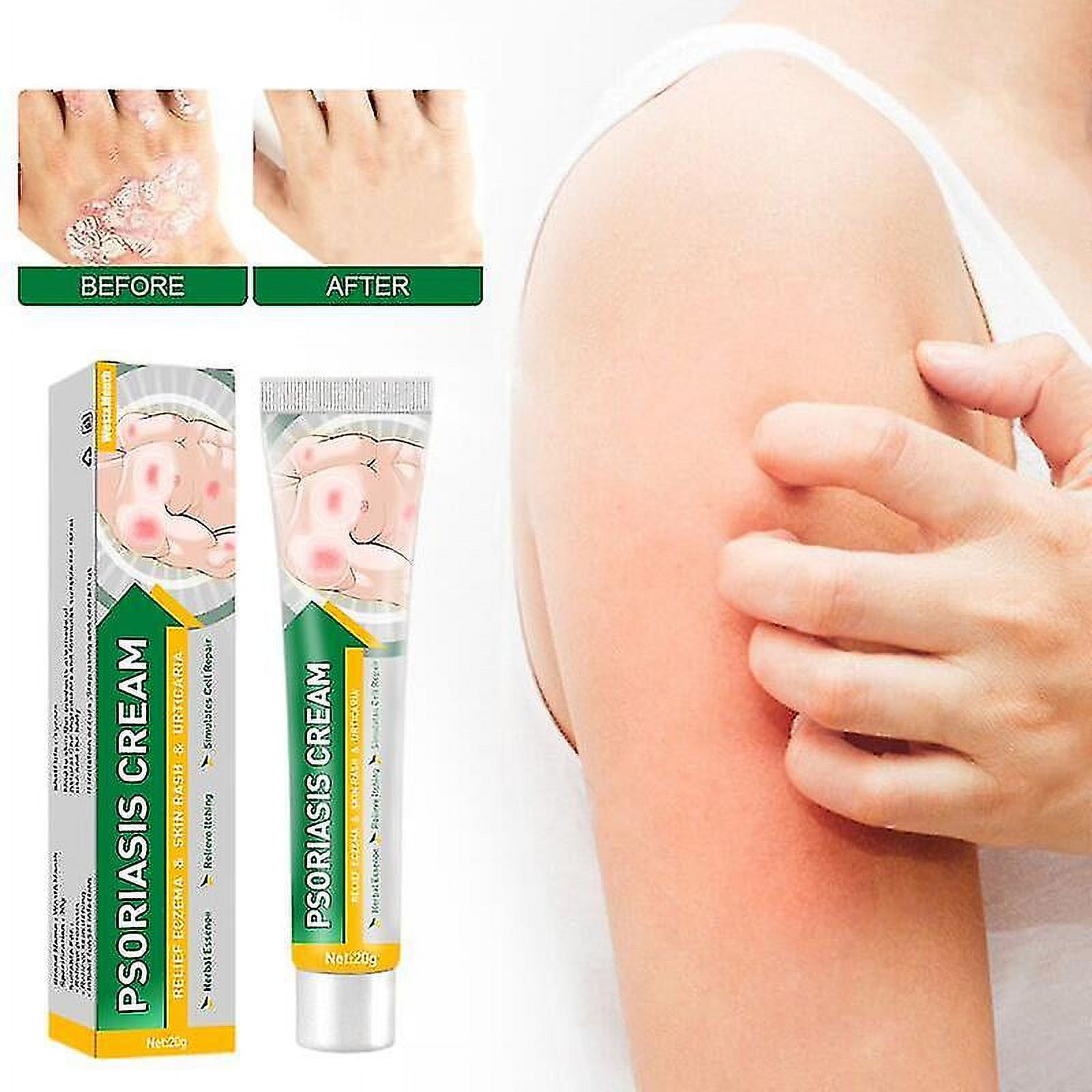 West&month Of Psoriasis Itching Relief Cream Antibacterial Pain Repair