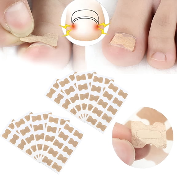 XIRQI Ingrown Toenail Correction Stickers, Painless Pedicure Toenail Corrector Patch Toenail Treatment Tool Foot Care (Quantity: 100 pieces)