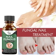 YUANHUILI Nail Fungus Treatment Whitening Toe Anti Infection Nail Care For Healthy Feet And Hands Nails Essence (50ml)