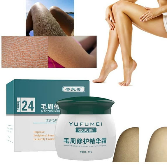 YiFudd Chicken Skin Cream For Removing Skin, Keratosis Cream Body Soothing Chicken Skin Treat Body Care Cream - Skincare for Men and Women