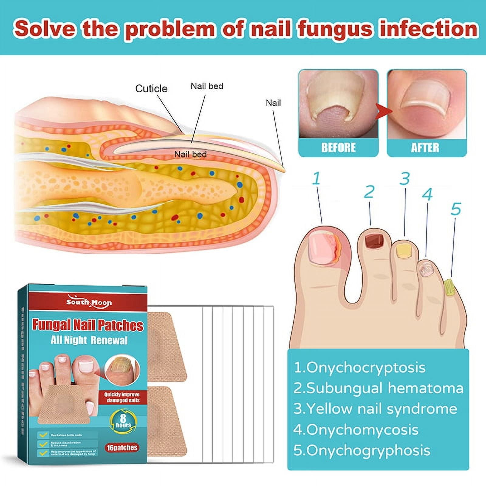 Yiget 16PCS Night Repair Correction Sticker Anti Fungal Toe Thickening