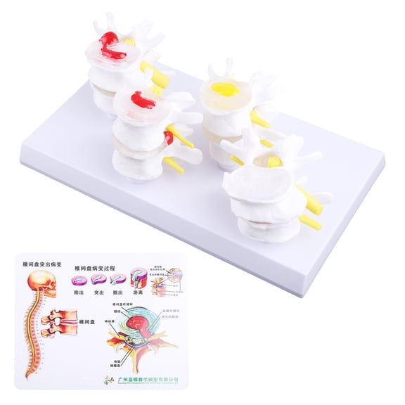 Yokua 1 Set Human Lumbar Lesion Spine Statue Display Model Medical Teaching Learning f