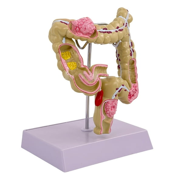 Yokua Human Anatomy Model Human Pathologies of Large Intestine Model Medicals Tool
