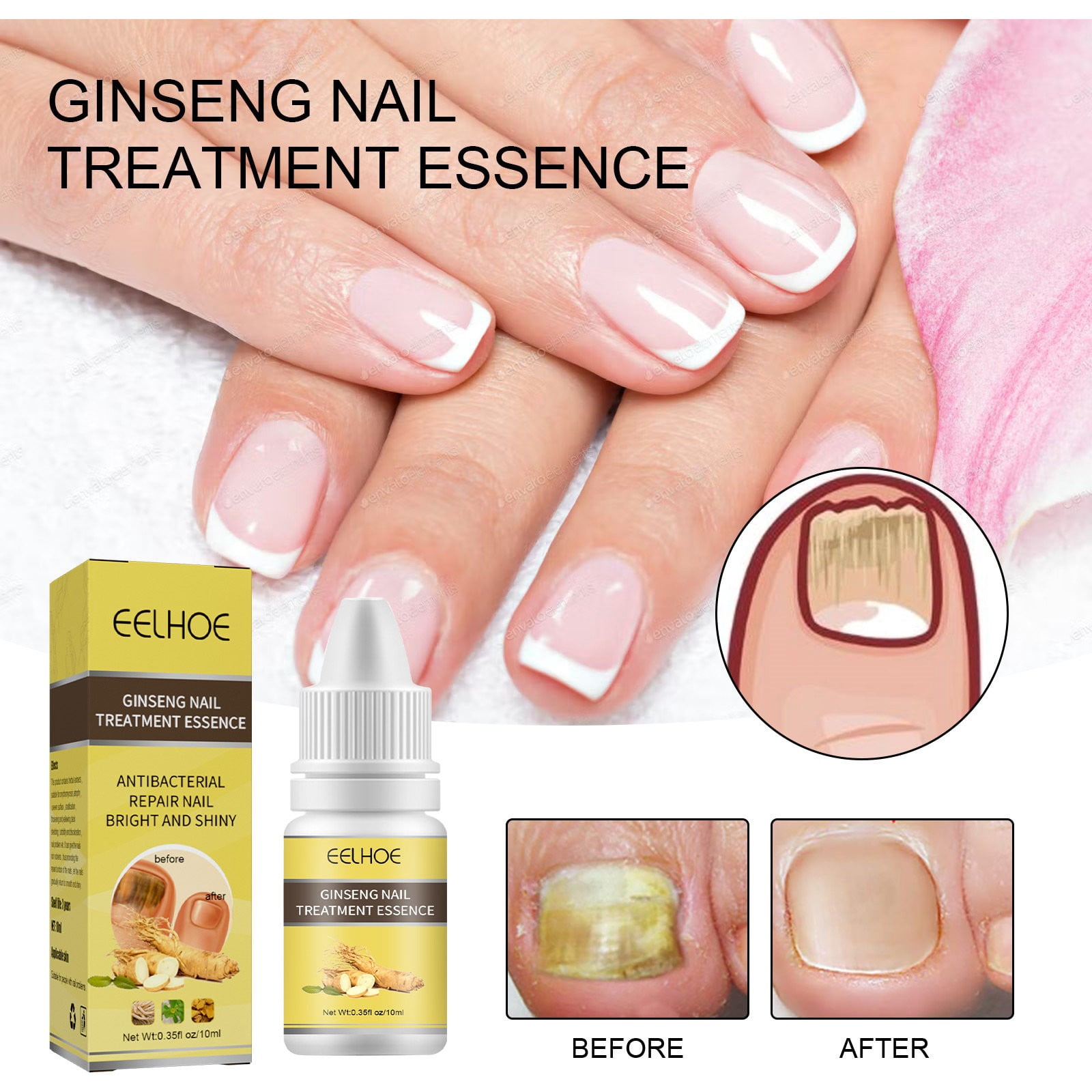 Yolaird Ginseng Onychomycosis Oil Antifungal Nail Treatment For Home