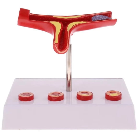 Yvsxxv PVC Atherosclerosis Vascular Display Science Models 1Pc