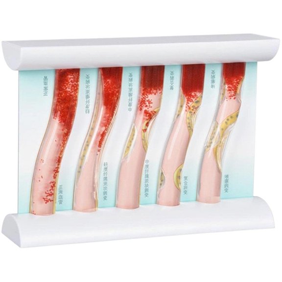 Yvsxxv Plastic Vascular Blockage Comparison Display Science Models 1Pc